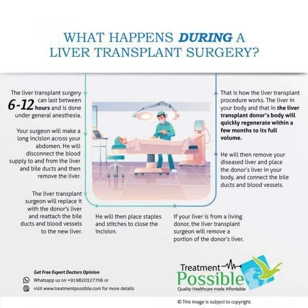 Know More About Liver Transplant In India Treatment Possible 3152