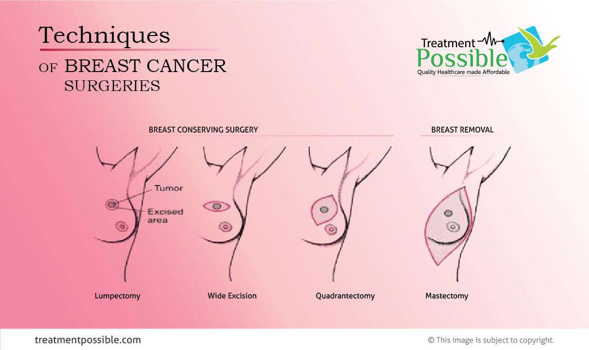 an infographic showing different techniques used for breast cancer treatment