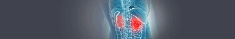 An image showing growth of cancerous cells in kidney