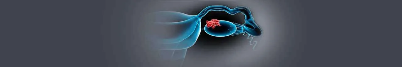 An image showing the ovaries affected by the cancer cells