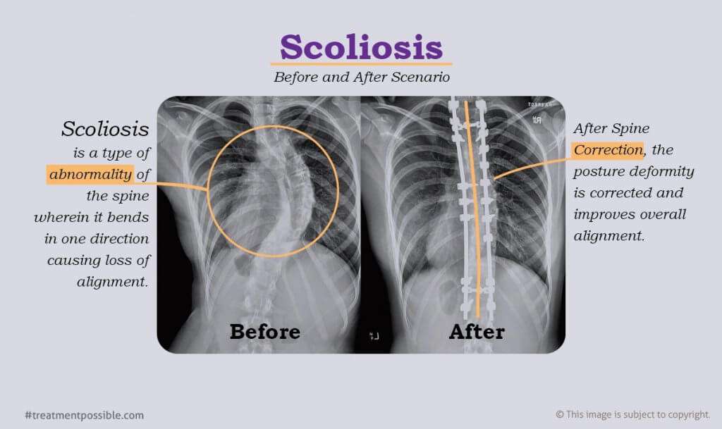 A picture showing the x-ray of a patients spine before and after the scoliosis correction surgery