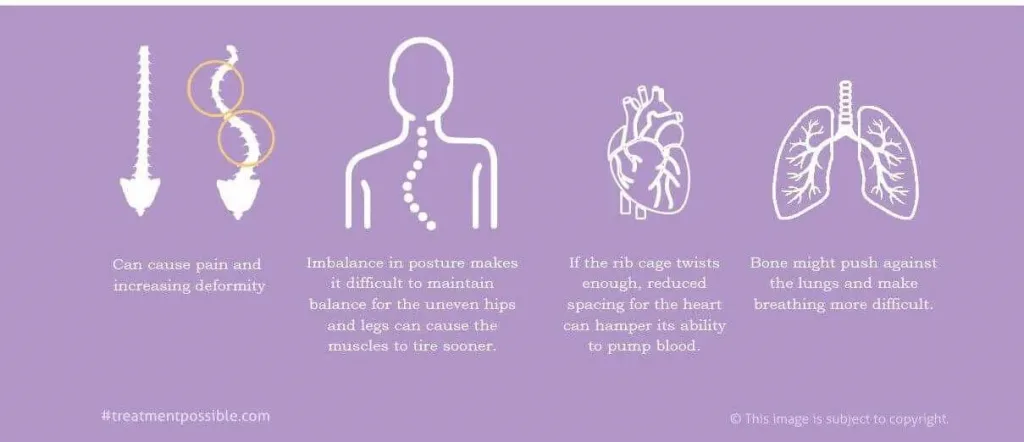 Symptoms of scoliosis is spine deformity, pain, imbalance in posture, breathing issues, cardiac problems, etc.