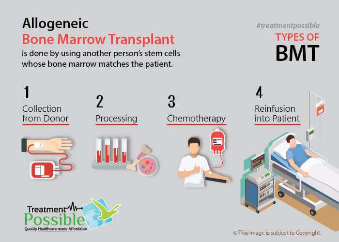 An infographic showing allogenic bone marrow transplant procedure