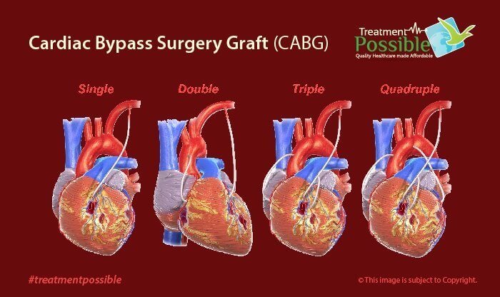 File:Coronary Artery Bypass Graft, Quadruple Wikipedia, 47% OFF