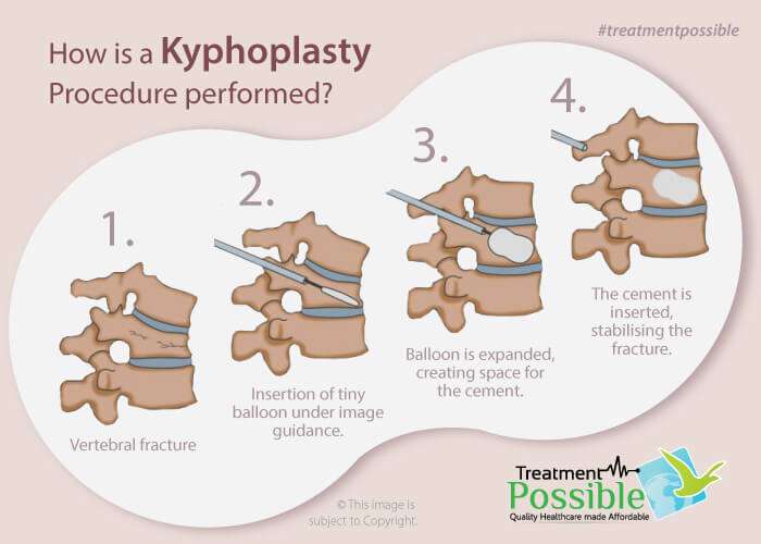 A digram which shows how the kyphoplasty surgery is performed.