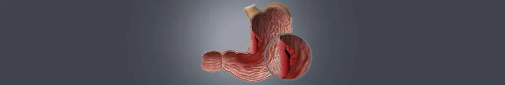 Stomach-cancer-treatment