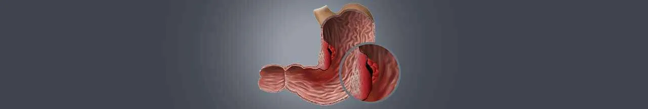 Stomach-cancer-treatment