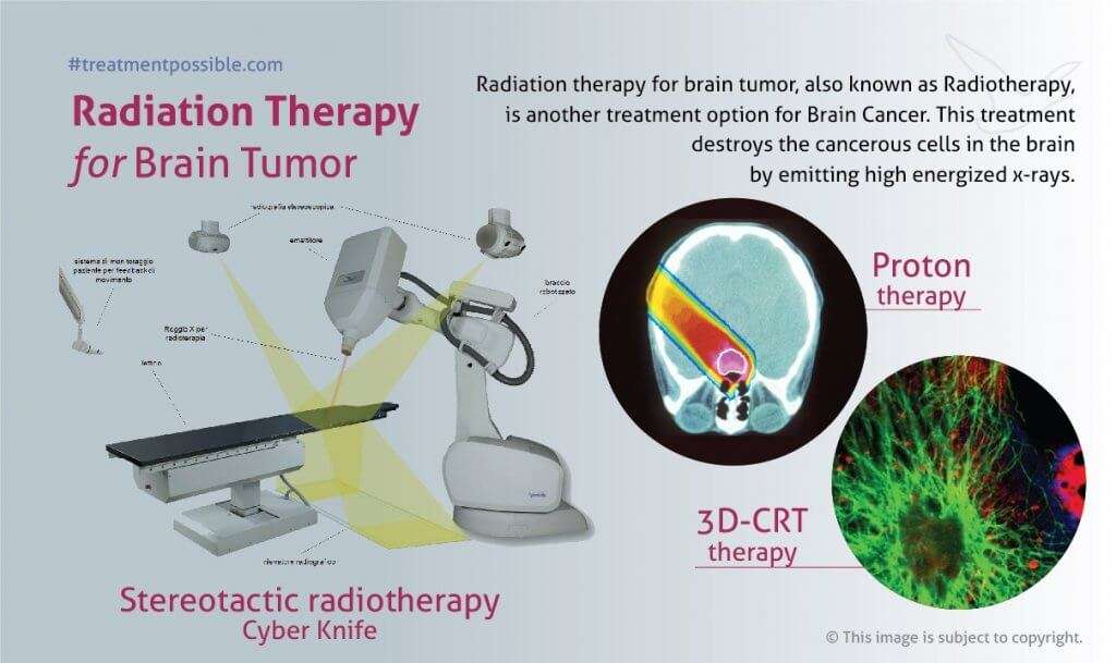 An infographic showing brain tumor treatment using radiation therapy