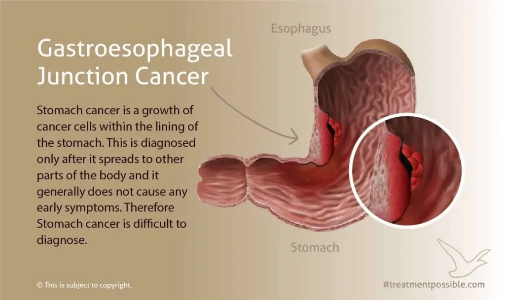 an infographic showing gastroesophageal stomach cancer