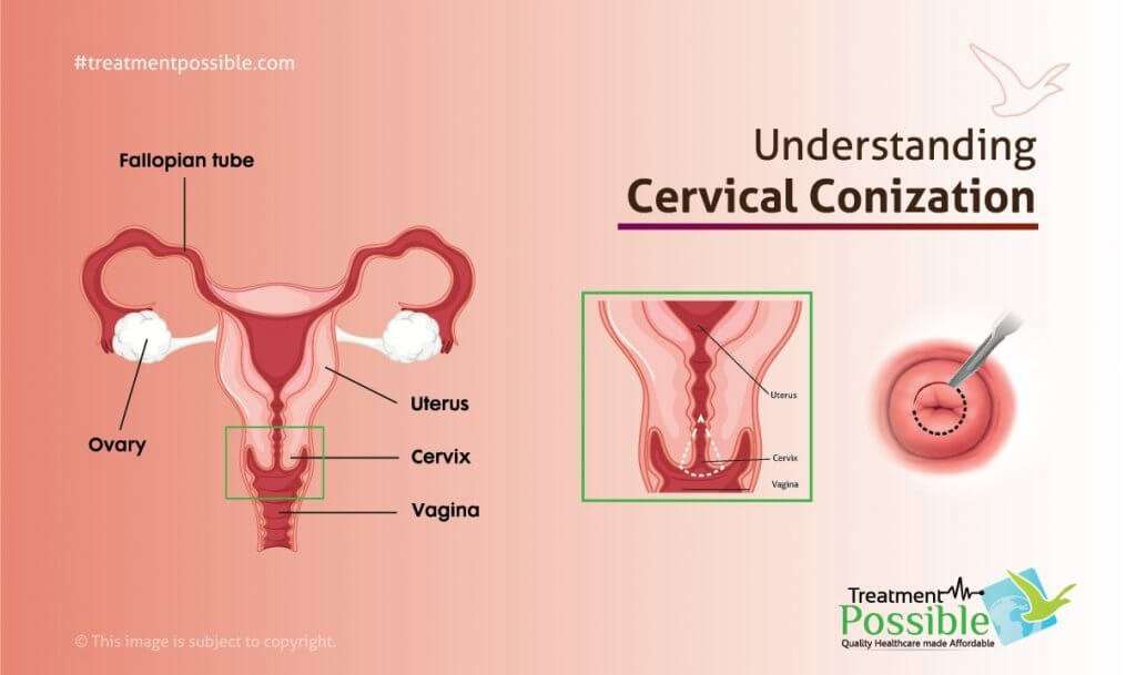 An Infographic explaining the Conization for Cervical Cancer