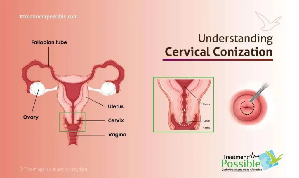 An Infographic explaining the Conization for Cervical Cancer