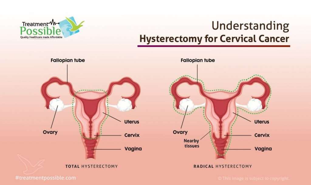 An Infographic explaining what is hysterectomy for cervical cancer treatment