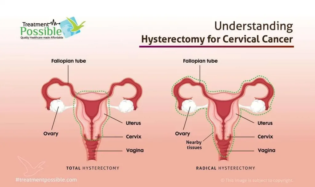 An Infographic explaining what is hysterectomy for cervical cancer treatment