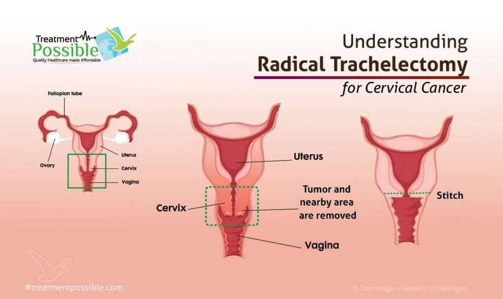 An Infographic explaining Radical trachelectomy for Cervical Cancer