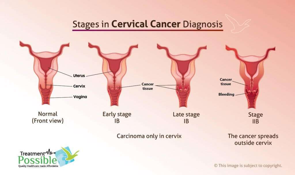 An Infographic explaining the stages of cervical cancer during diagnosis