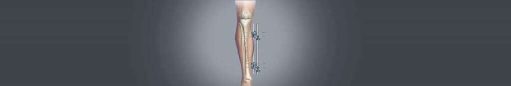 Limb lengthening surgery in India banner