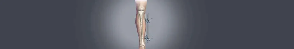 Limb lengthening surgery in India banner