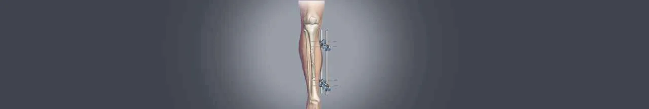 Limb lengthening surgery in India banner