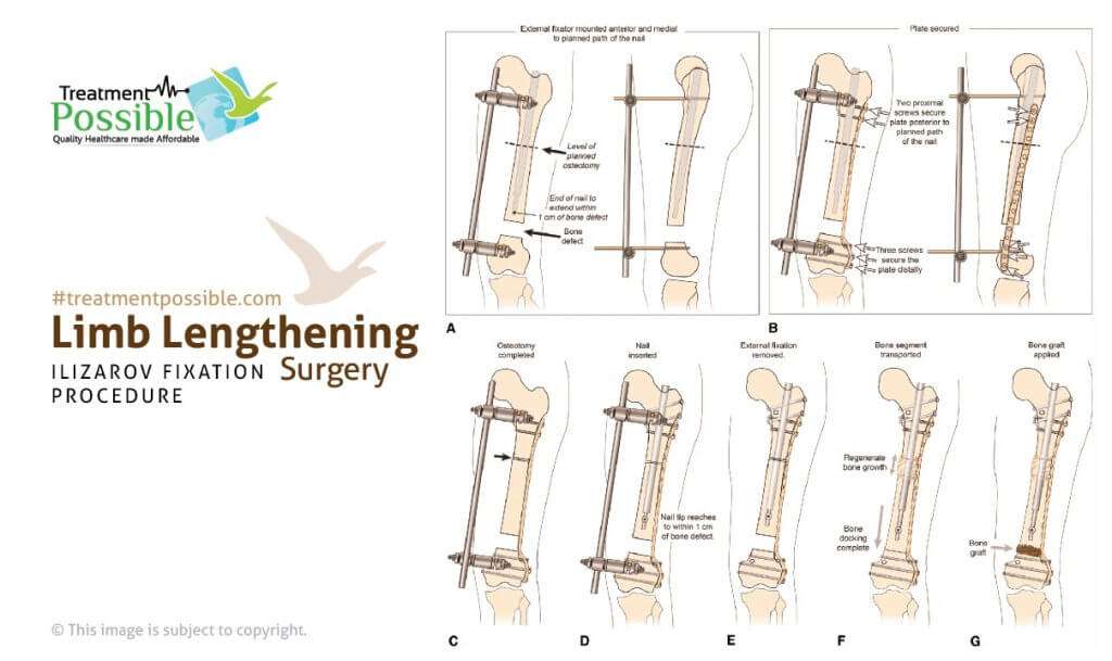 Infographic on limb lengthening surgery in india also known as ilizarov fixation procedure