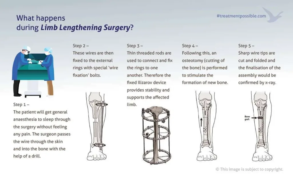 An infographic explaining ilizarov fixation procedure