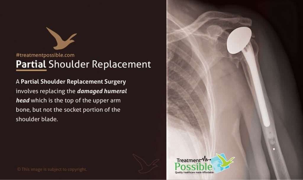 An infographic explaining partial shoulder replacement surgery
