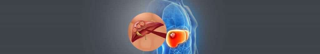 Liver Cancer Treatment In India
