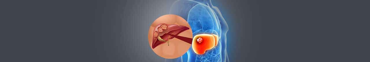 Liver Cancer Treatment In India