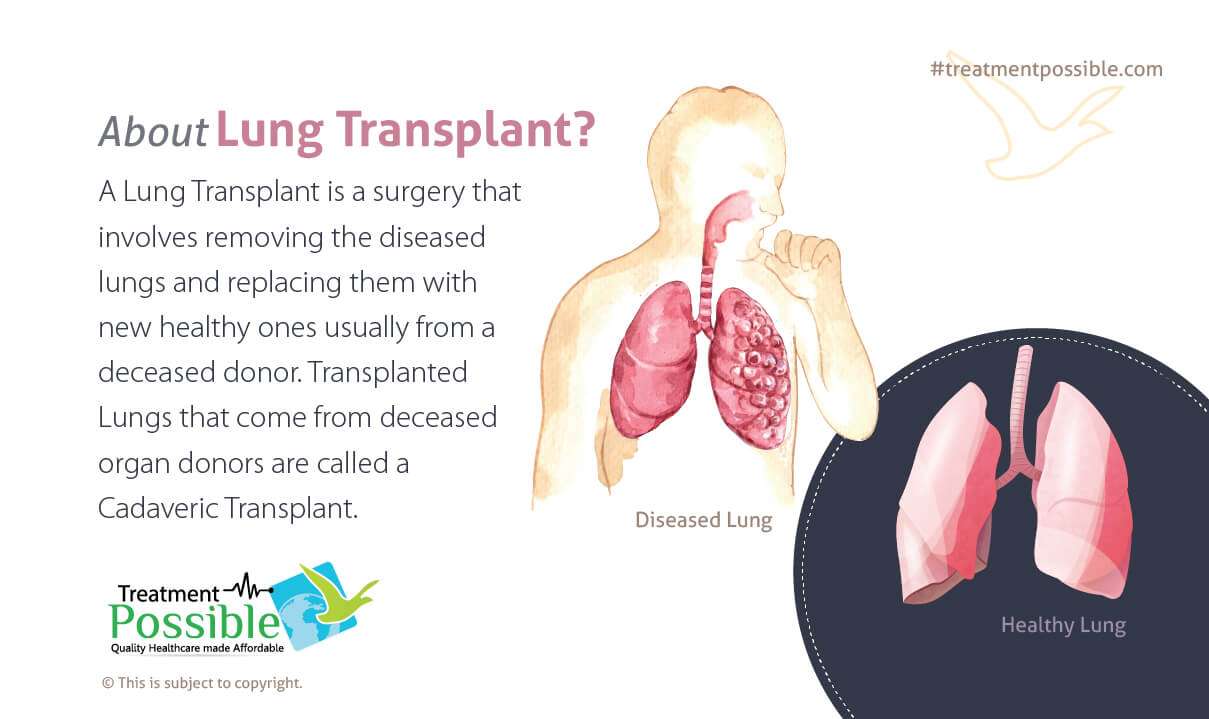 The infographic explains about the lung transplant surgery in India