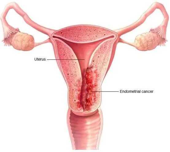 What is Endometrial cancer