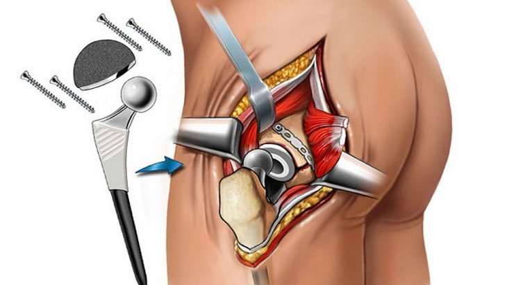 how is Hip replacement surgery performed