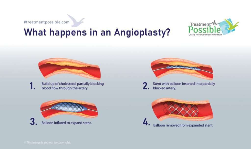 Coronary Angioplasty In India