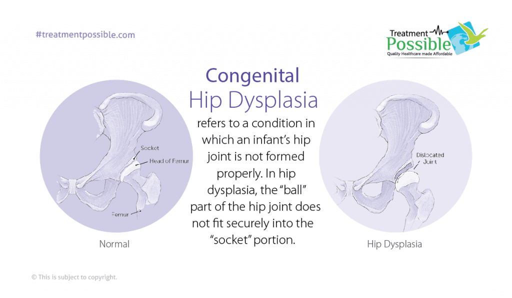 What is congenital hip dysplasia