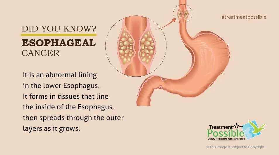 about esophagael cancer