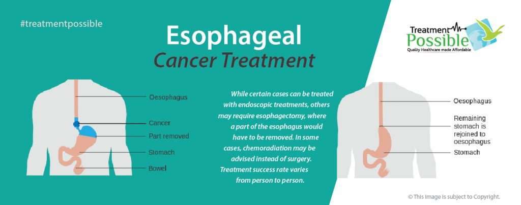 esophagael cancer treatment in india