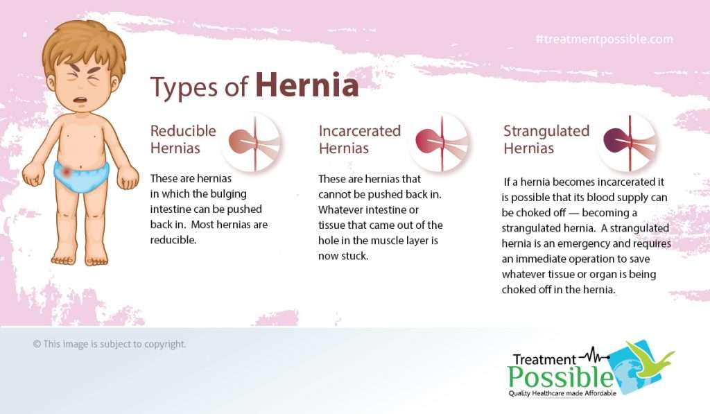 Types of hernia in kids
