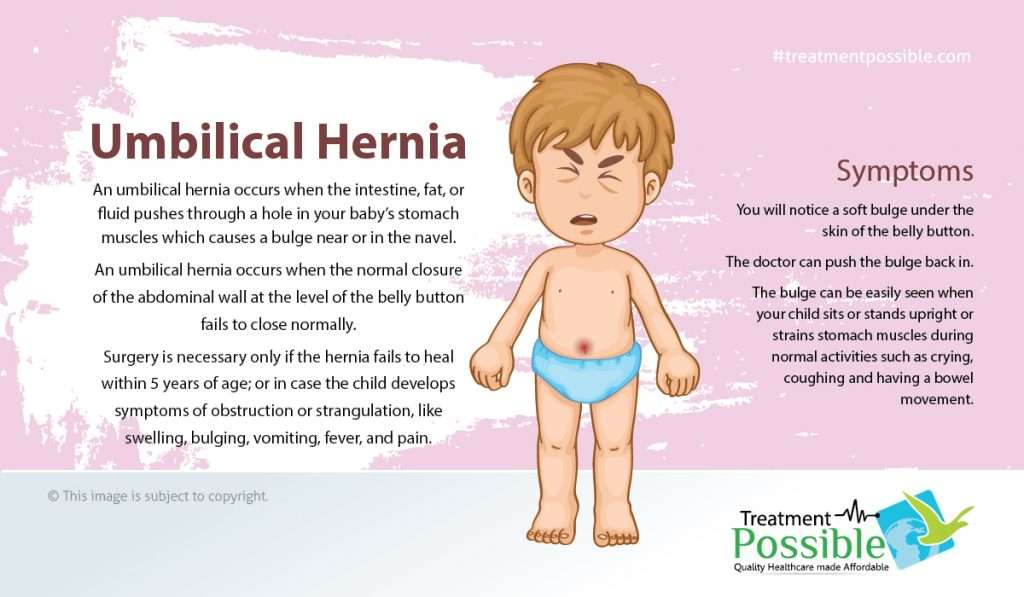symptoms of umbilical hernia