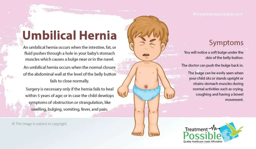 symptoms of umbilical hernia