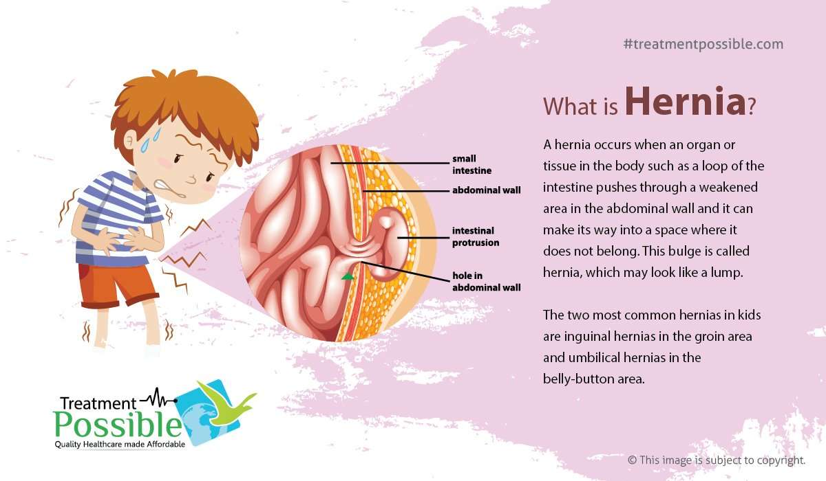 Pediatric Hernia Treatment