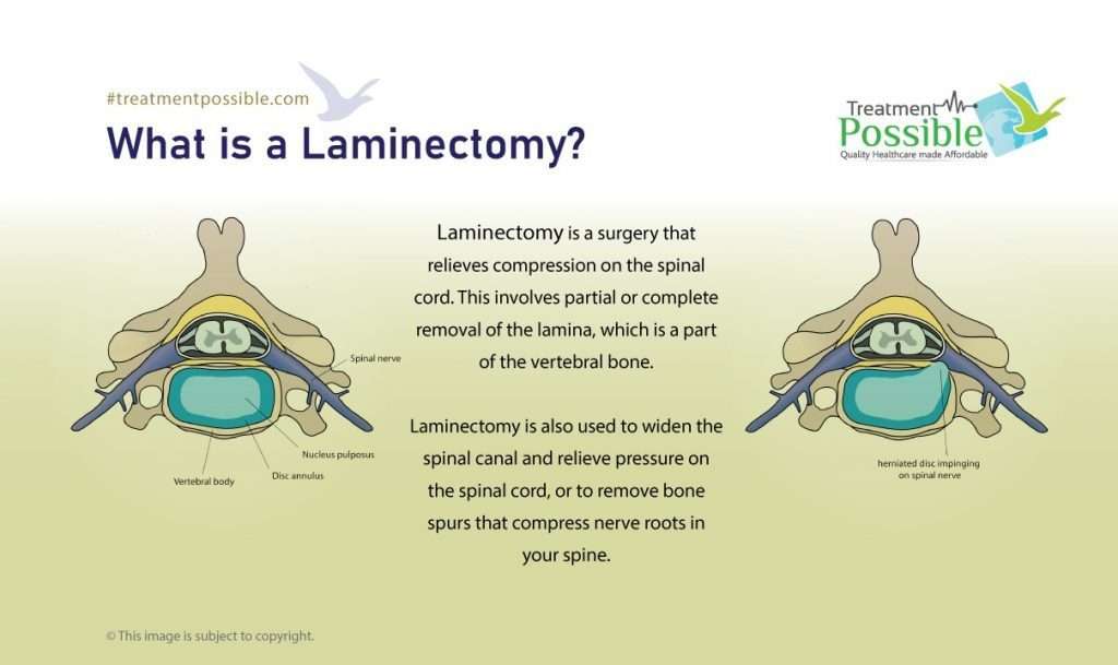 laminectomy spine surgery in india