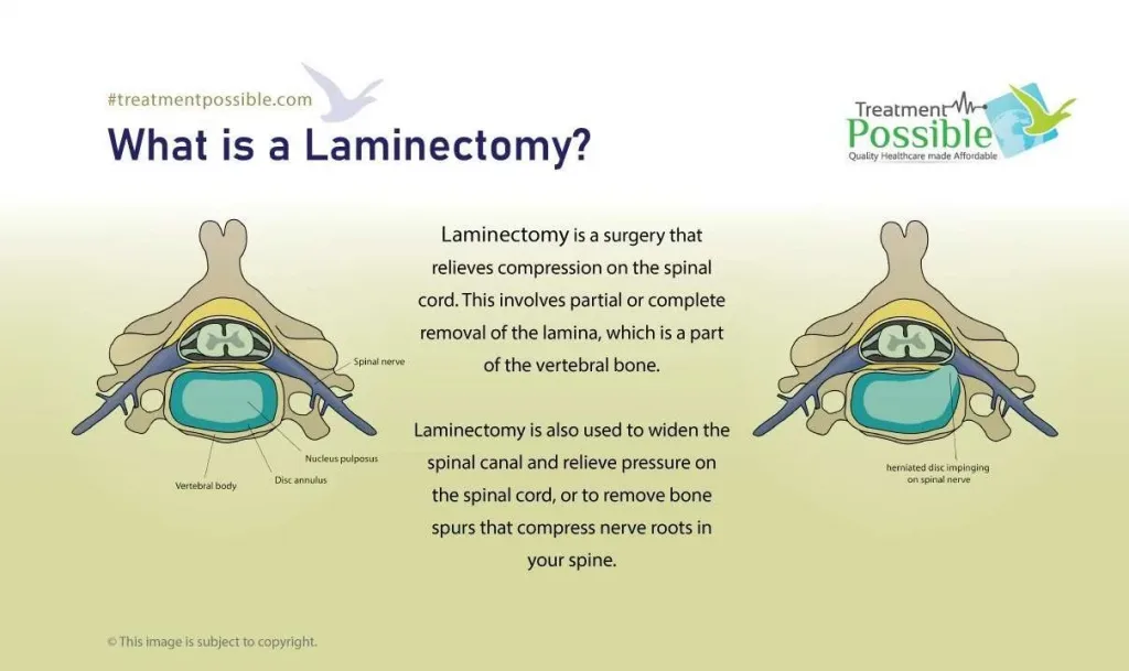 laminectomy spine surgery in india