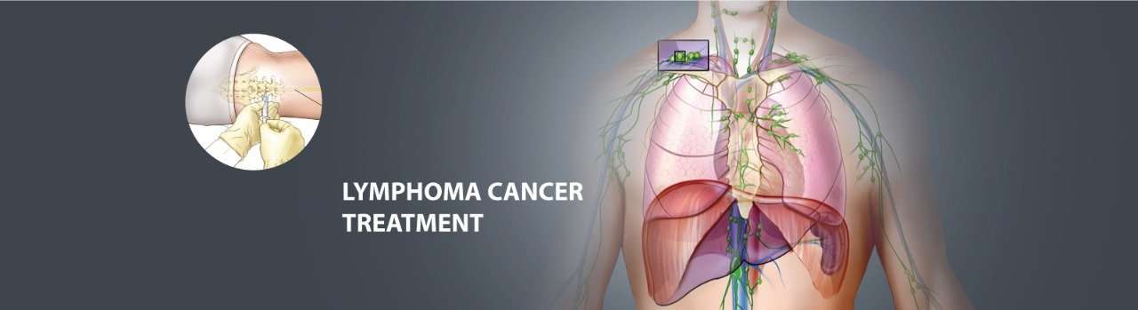 Lymphoma cancer treatment