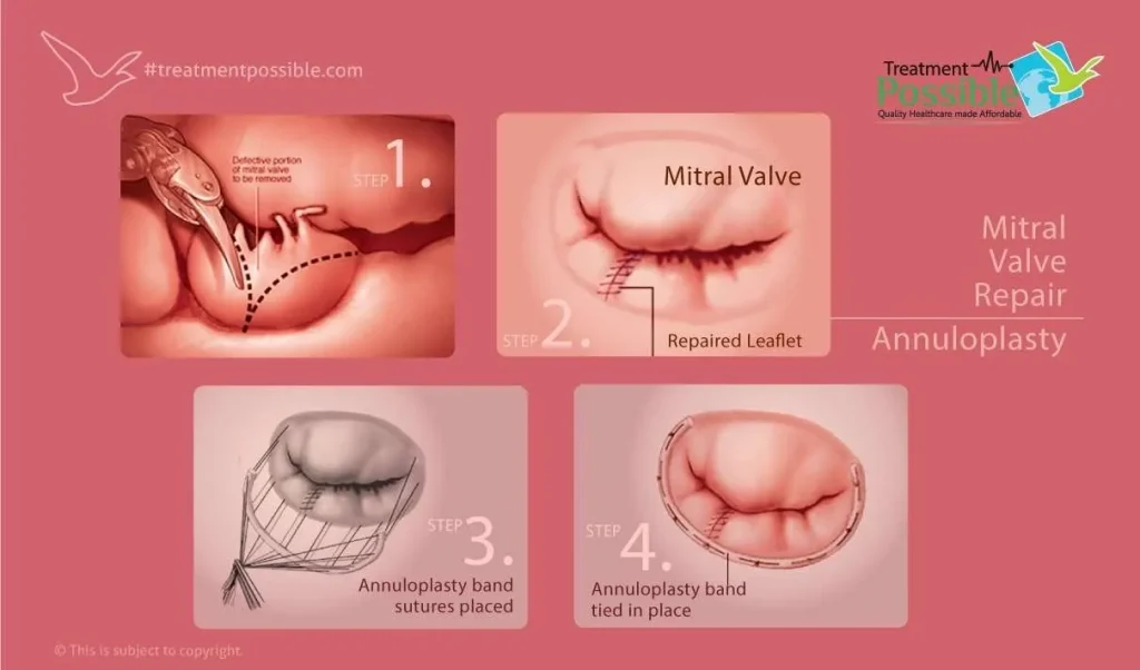 mitral valve repair in india