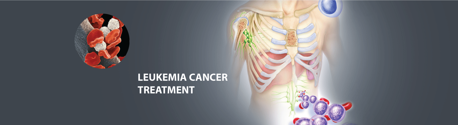 Leukemia Treatment