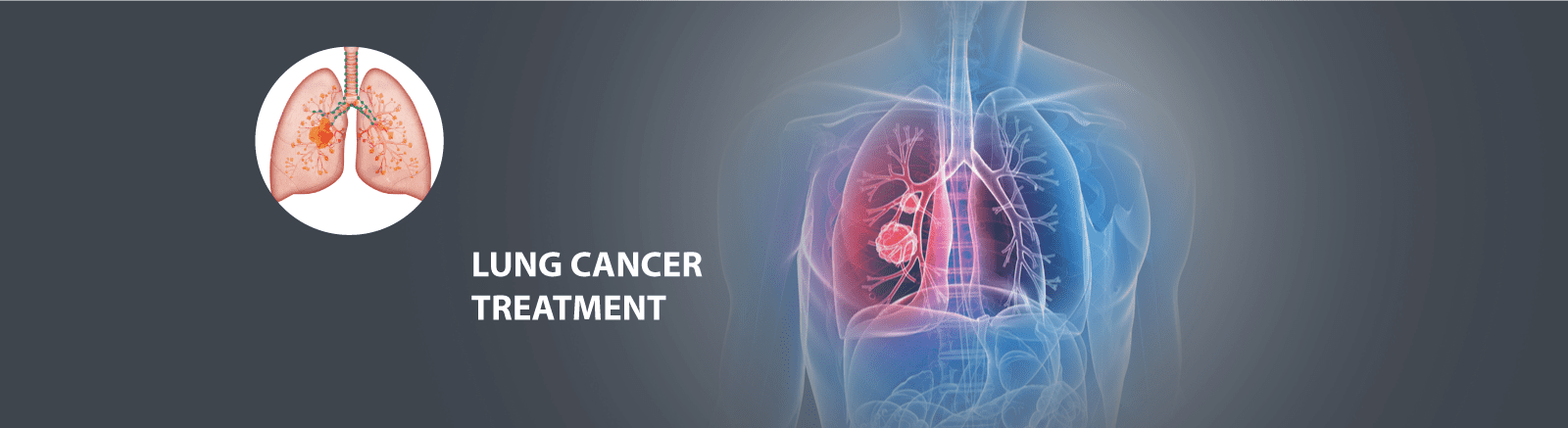 Lung Cancer Treatment