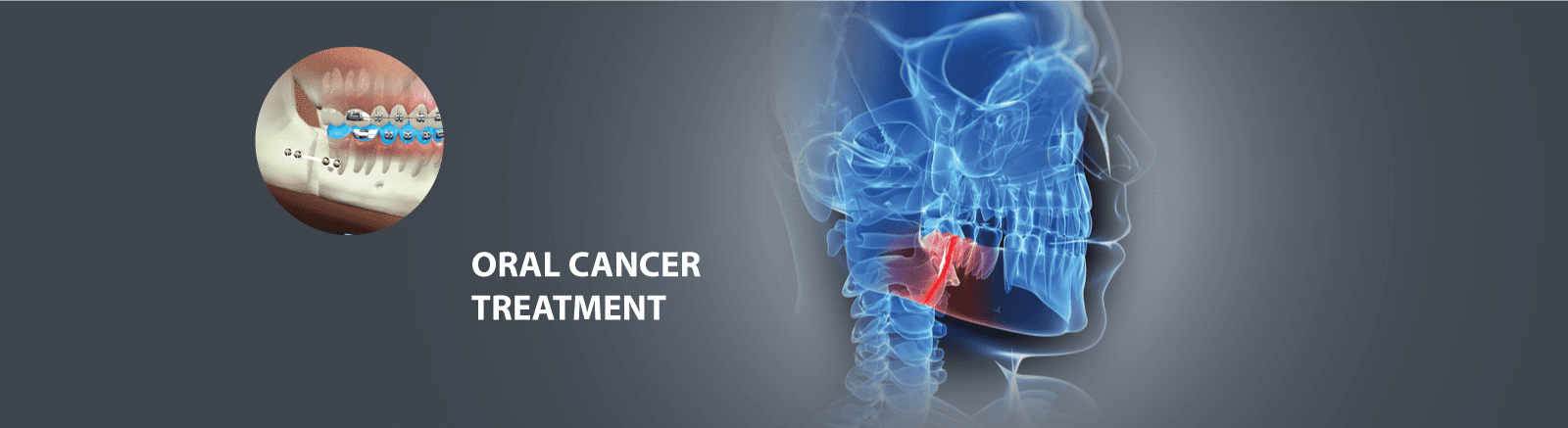 Oral Cancer Treatment
