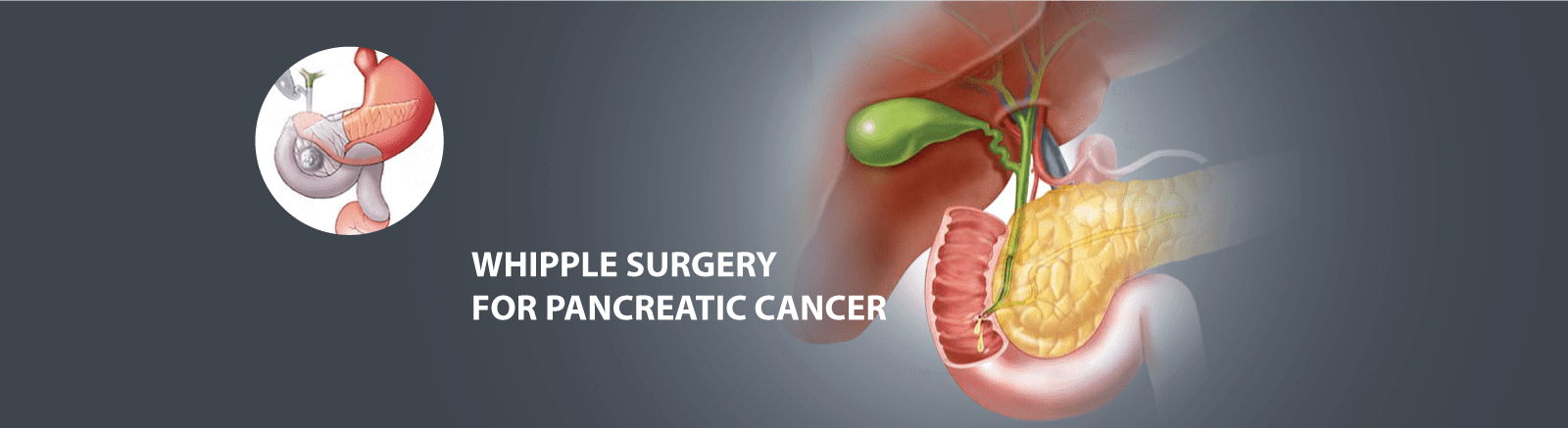 Pancreatic Cancer Treatment